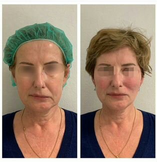 Скидка 50 на нитевой лифтинг. К тренеру моделью